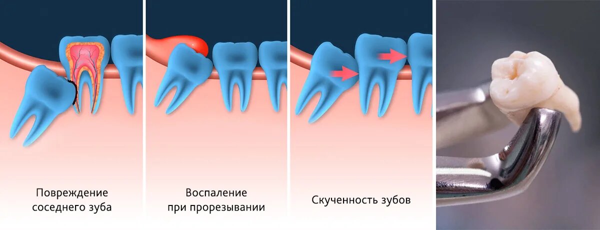 Чем вреден зуб мудрости