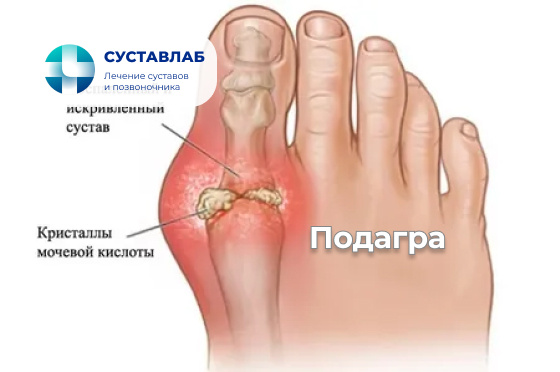 Подагра: почему болит большой палец ноги