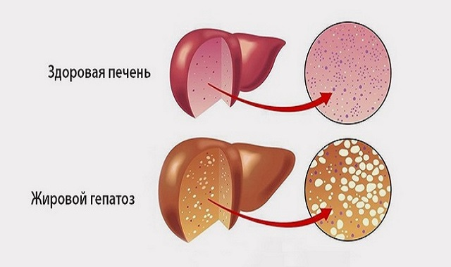 Изменения структуры печеночной ткани при ультразвуковом исследовании.  expert-clinica.ru