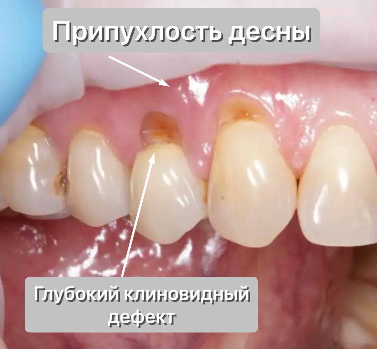 Глубокий клиновидный дефект