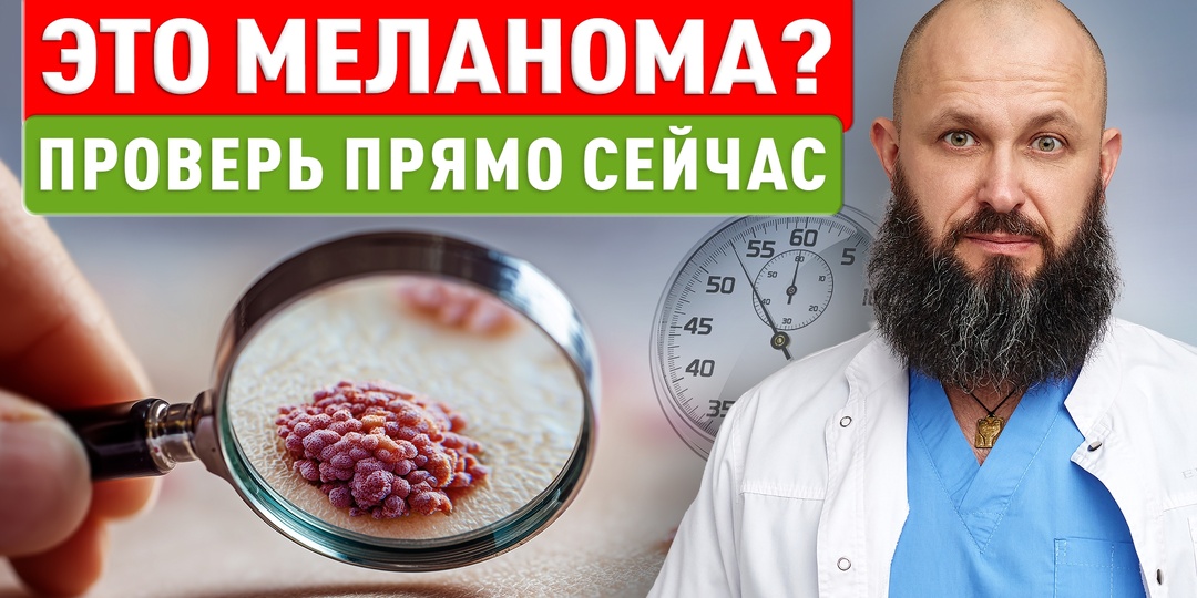 Необычная родинка оказалась меланомой. История пациентки