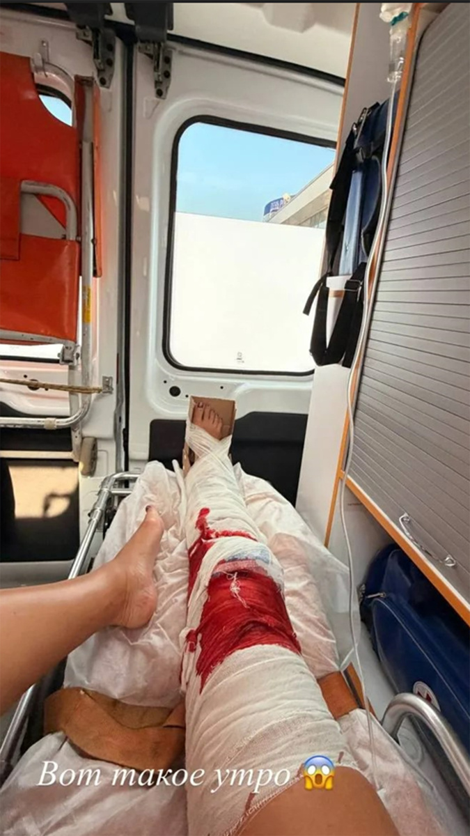    Ольга Бузова показала свою окровавленную ногу. Фото: соцсети Ольги Бузовой