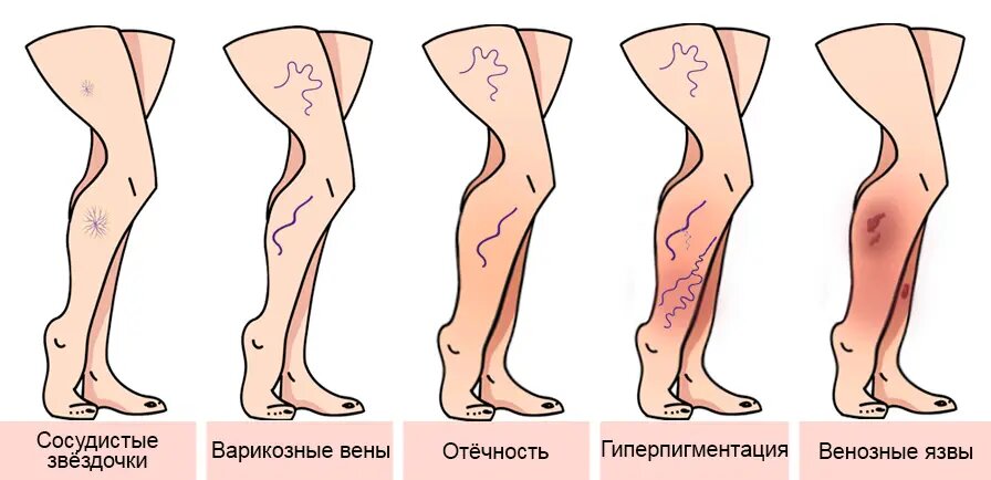 Почему китайцы не страдают варикозом: 1 привычка, которую высмеивают европейцы