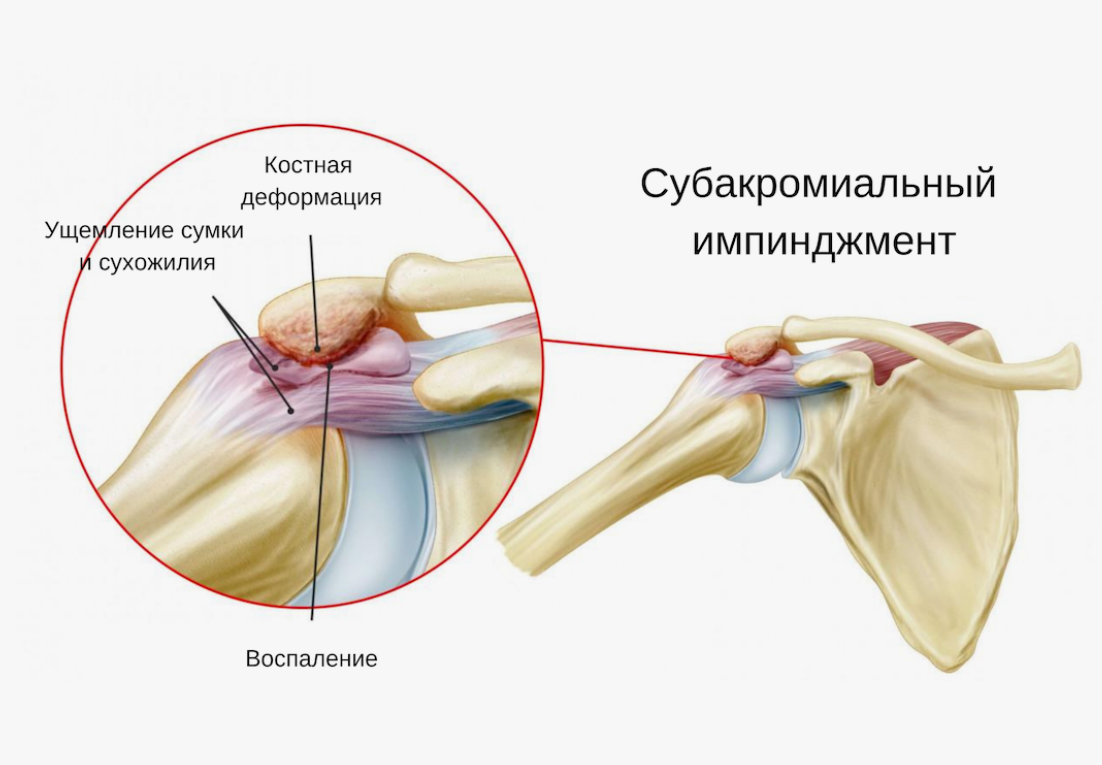 Структуры субакромиального пространства. Компрессия сухожилия надостной мышцы между головкой плеча и акромионом — центральное звено импинджмент-синдрома