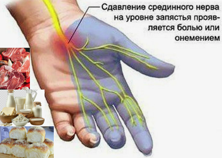 Отёк внутри запястья давит на нерв — и пальцы немеют