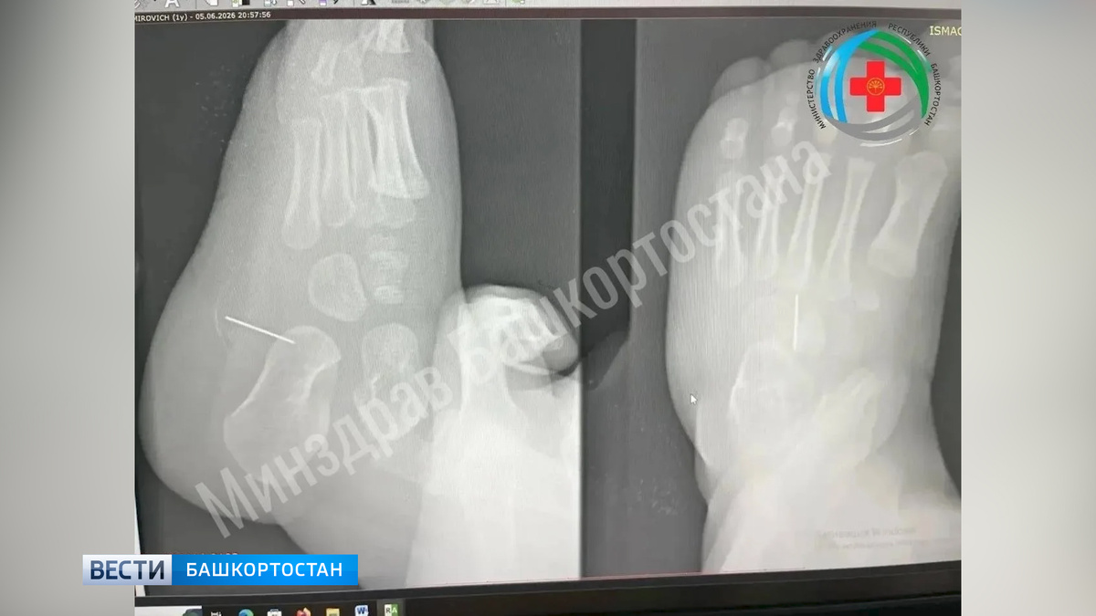    Двухсантиметровую иглу извлекли из стопы полуторагодовалого ребенка в Башкортостане