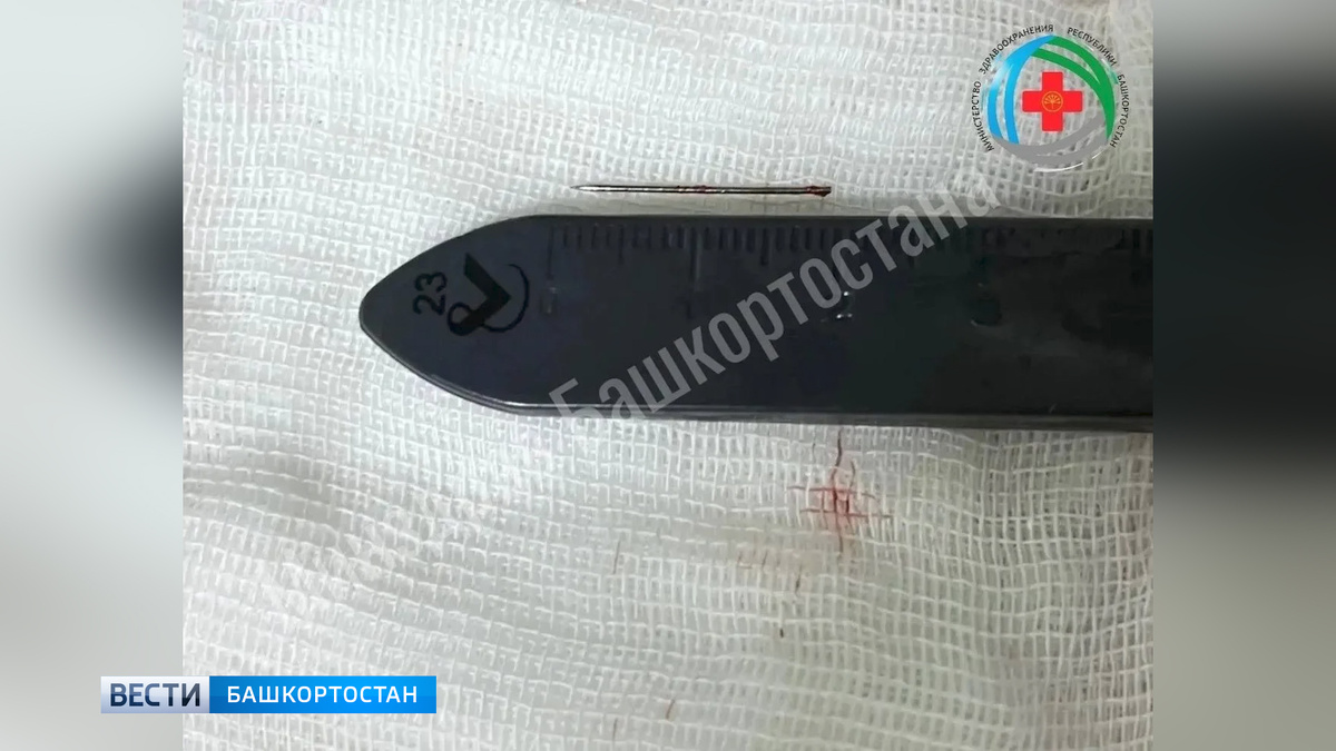   Двухсантиметровую иглу извлекли из стопы полуторагодовалого ребенка в Башкортостане
