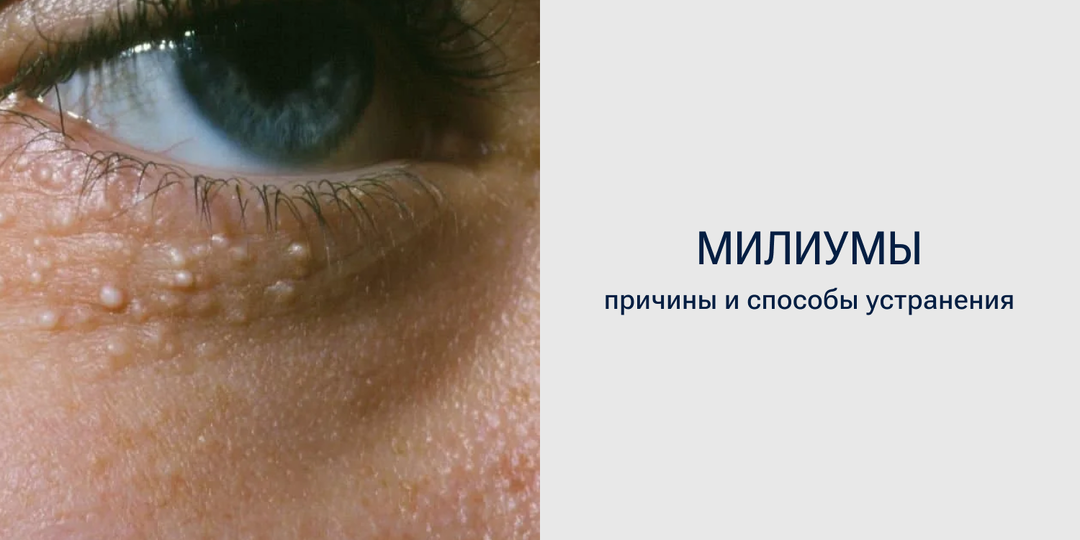«Просянка» под глазами. Как убрать милиумы: причины и пошаговый уход