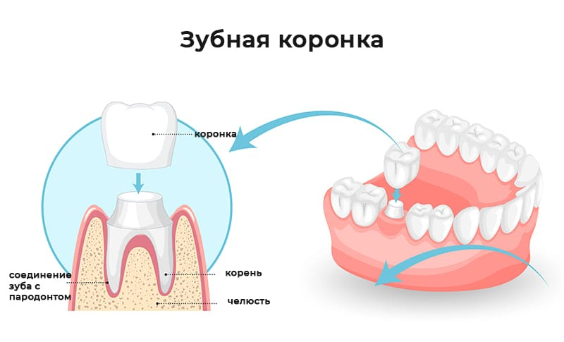 Зубная коронка