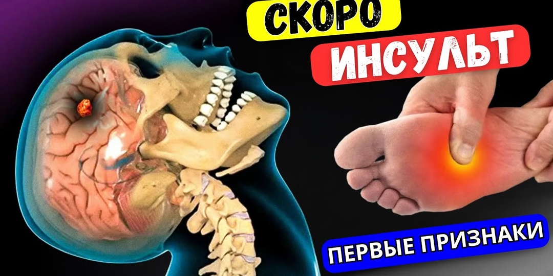 8 сигналов, указывающих на скорый инсульт? Неврологи объяснили, какие признаки требуют внимания
