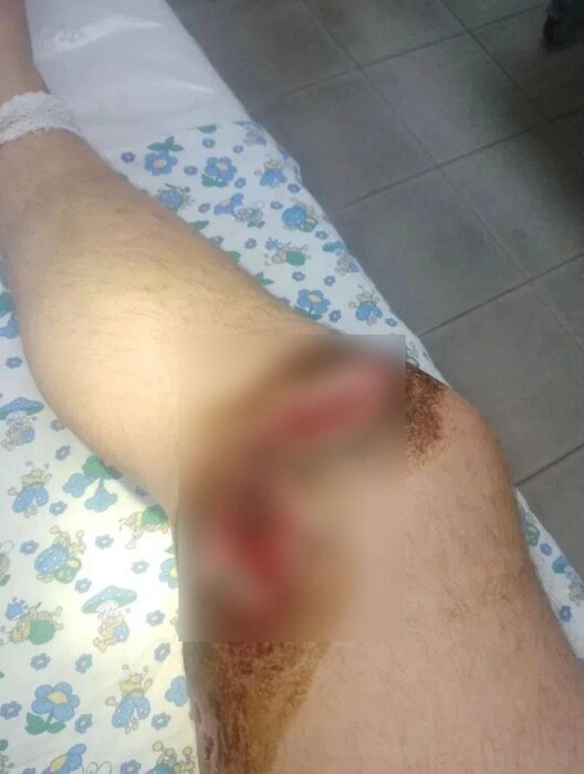 Мужчине буквально разорвали ногиИсточник:Дмитрий Асеев