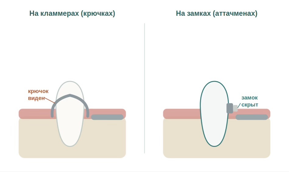 Слева — крепление на кламмерах (металлический крючок виден). Справа — на замках: аттачмен скрыт под коронкой.