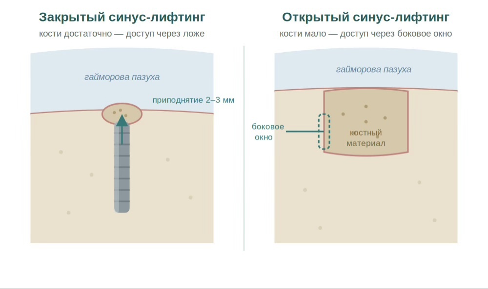 Слева — закрытый синус-лифтинг (доступ через ложе импланта). Справа — открытый (доступ через боковое окно, значительное наращивание).