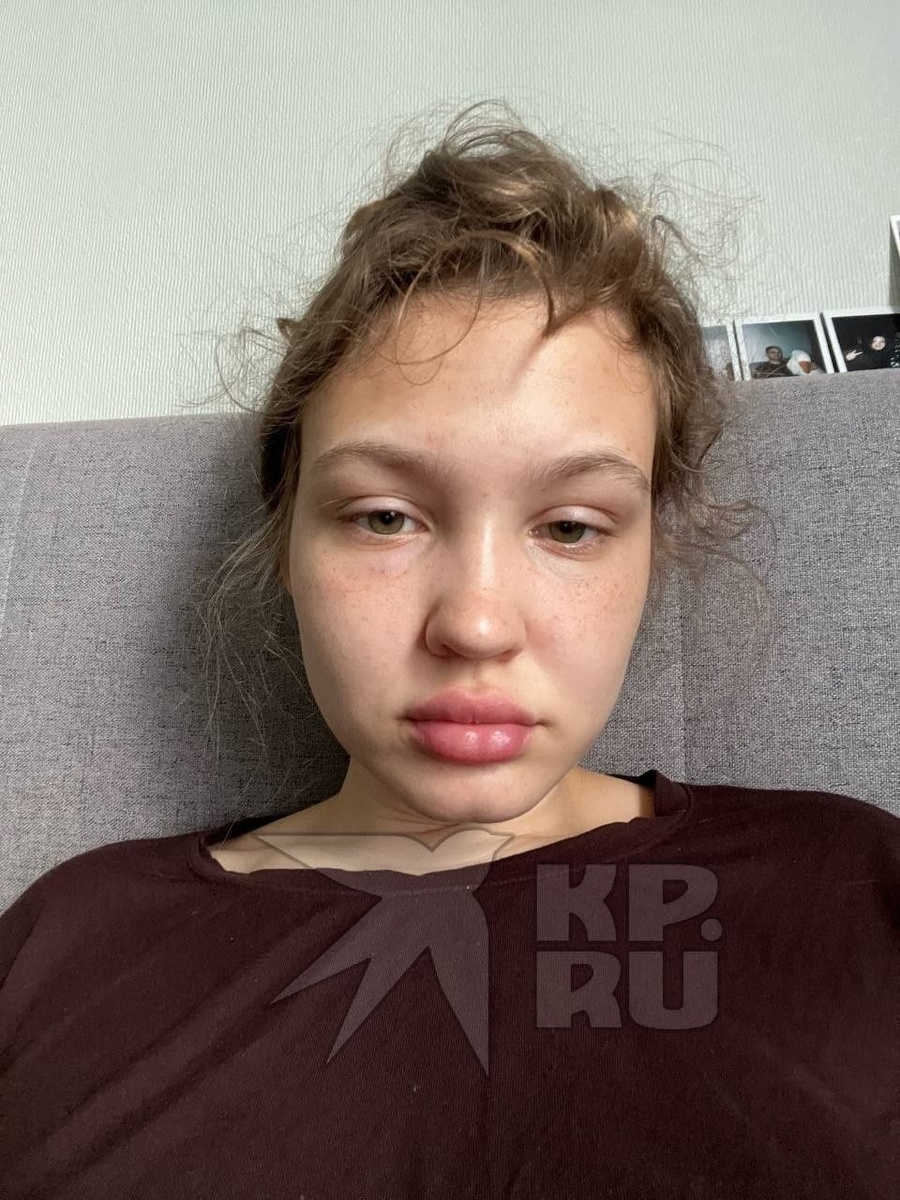    18 июня Анастасия проснулась с опухшим лицом. Фото: читатель "КП"
