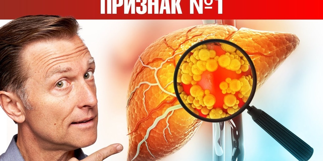 3 признака того, что у человека жирная печень? Врачи объяснили, как организм подаёт сигналы