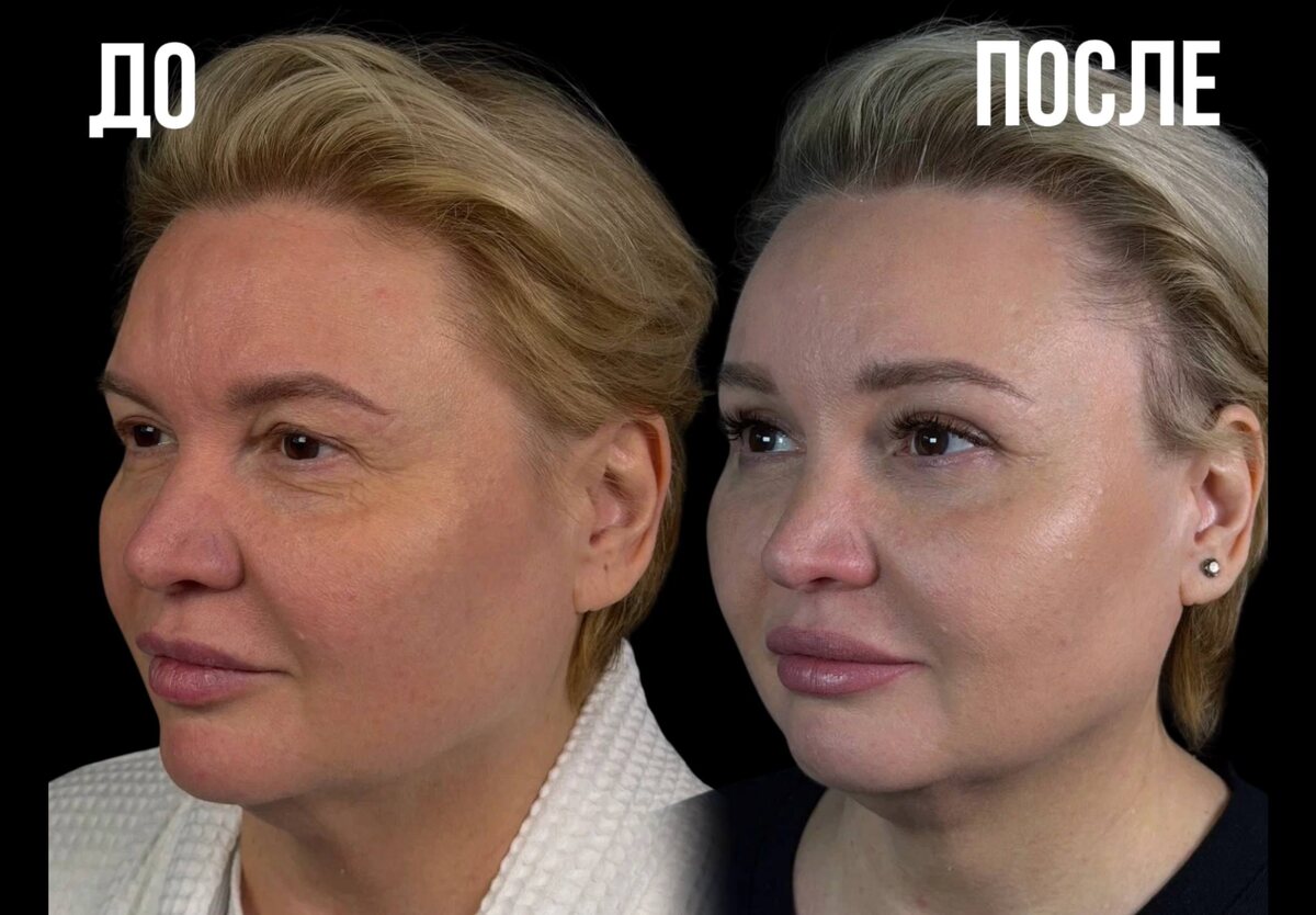 Моя пациентка до и после преображения. 