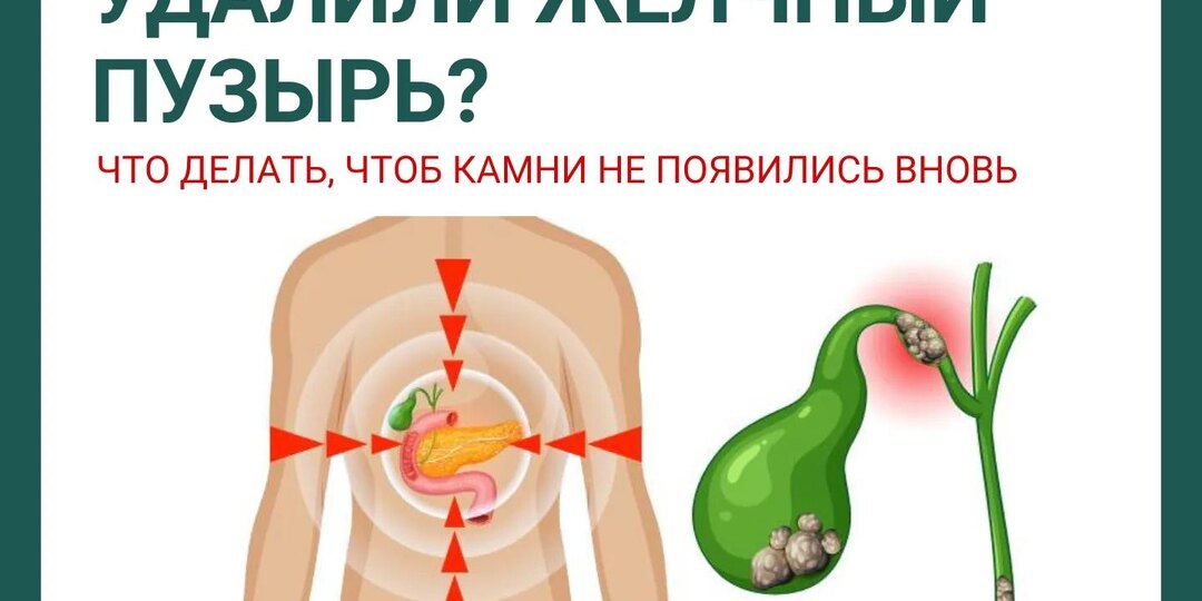Удалили жёлчный пузырь? Главное - не повторять ошибку, которая возвращает камни