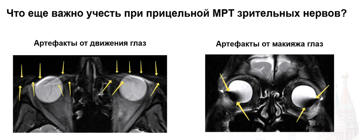 артефакты - помехи 