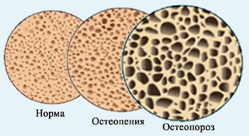 Потеря мышц напрямую связана с болезнями