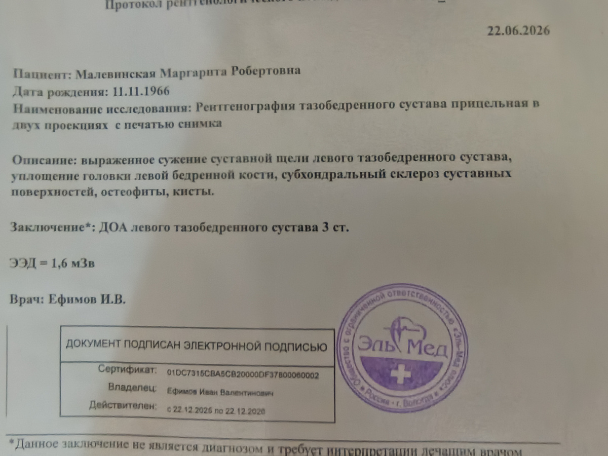 Я была уверена, что артроз 2-3 ст. примерно. Сужение щели сустава ожидаемо, но вот остальное.. Многовато как-то за прошедшие 10 лет негативных изменений: субхондральный склероз суставных поверхностей, уплощение головки т. б. кости, остеофиты, да еще и кисты.. 