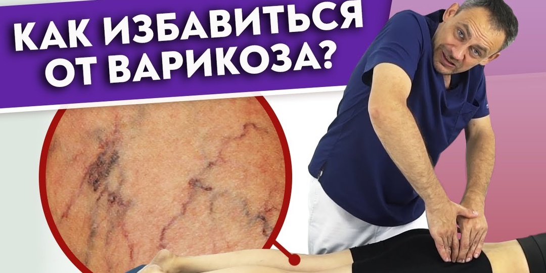 Как убрать ВАРИКОЗ? Варикозное расширение вен — причины и помощь