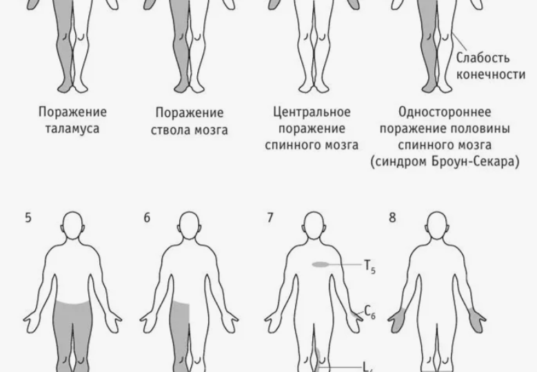 Спастичность при травме спинного мозга
