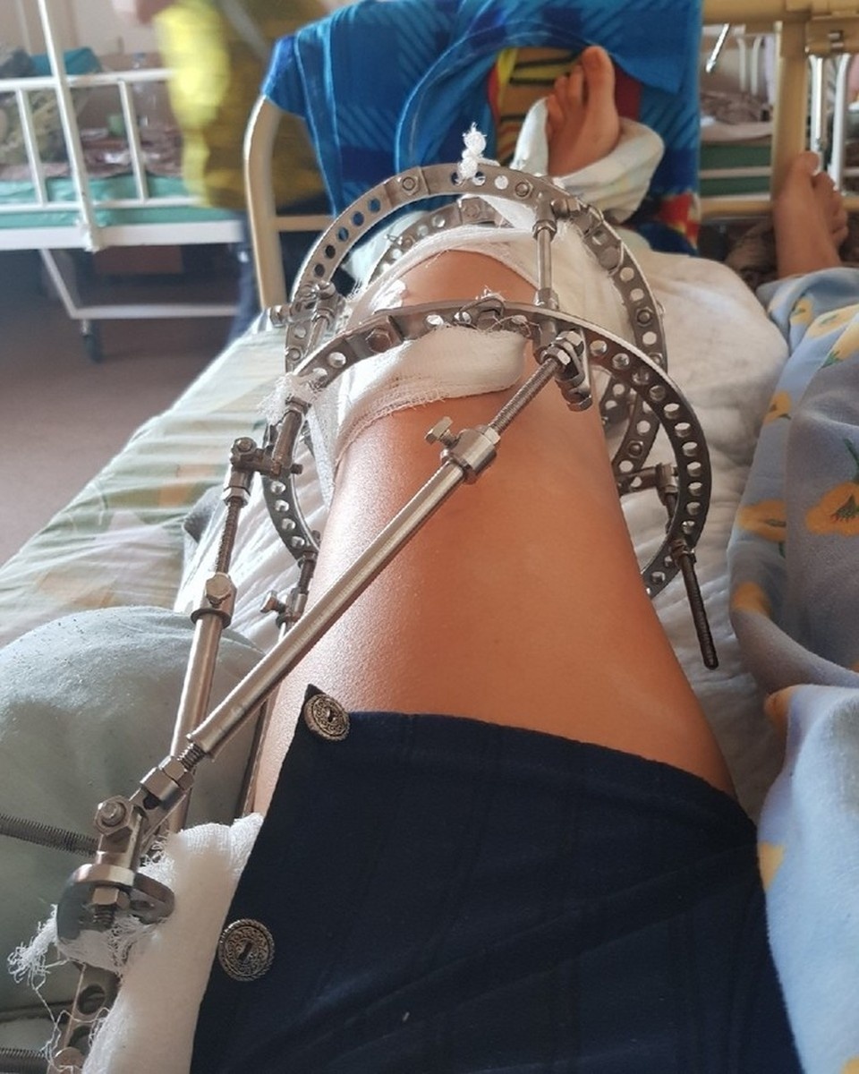    В дальнейшем женщине может понадобиться еще одна операция для окончательного восстановления ноги.