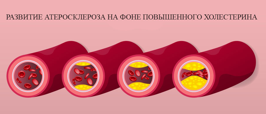 Холестерин - новые правила игры: что изменили кардиологи и почему это касается каждого