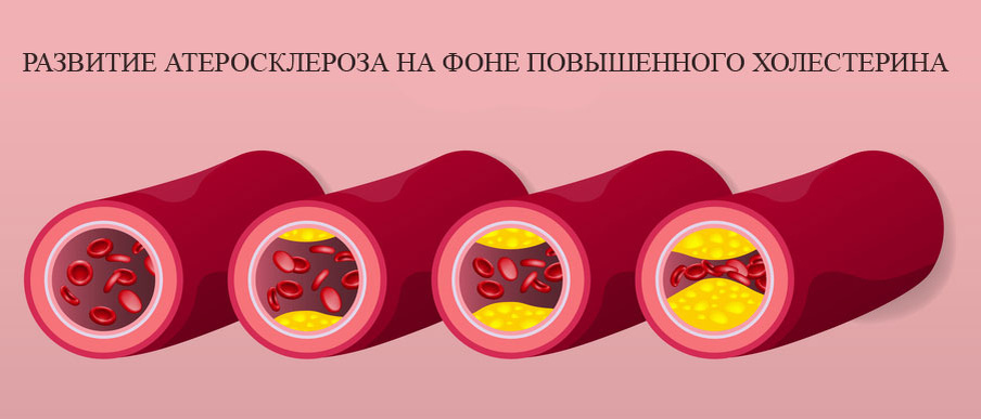 Холестерин - новые правила игры: что изменили кардиологи и почему это касается каждого