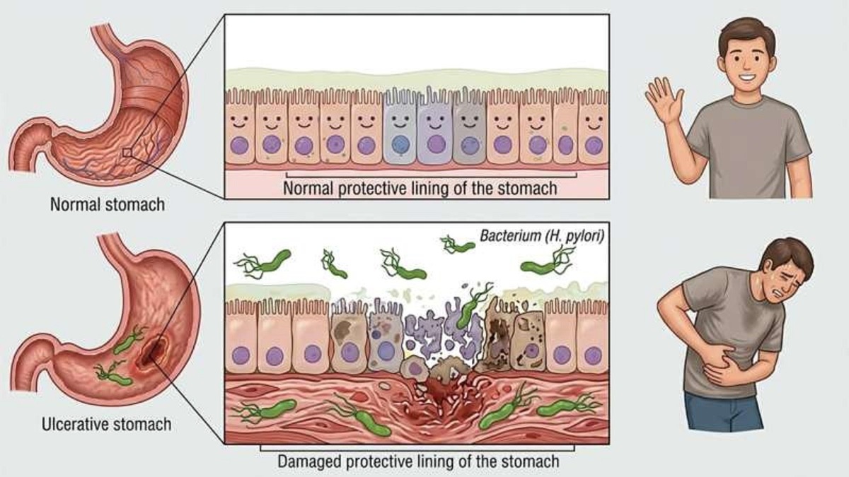    Бактерии Hekiconacter pylori живут в ЖКТ большинства людей. Они не обязательно провоцируют язву. Но сочетание «благоприятных» факторов (стресс, неправильное питание, курение, алкоголь) повышает их шансы сделать черное дело.