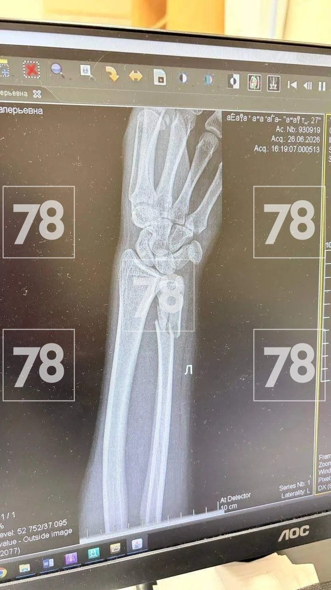 -2