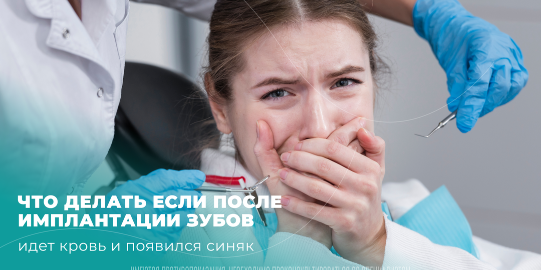 Что делать, если после имплантации зубов сильно опухла щека и пошла кровь