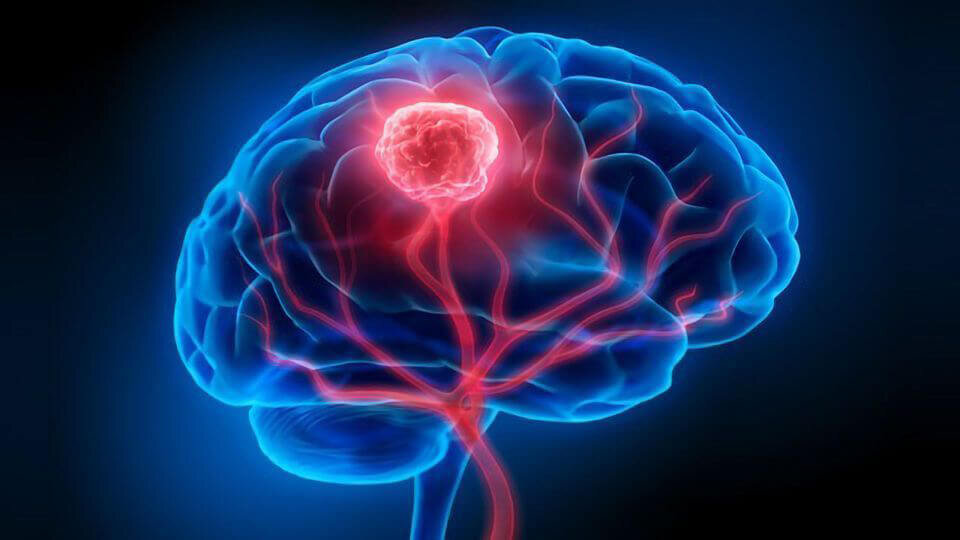Это открытие может победить глиобластому