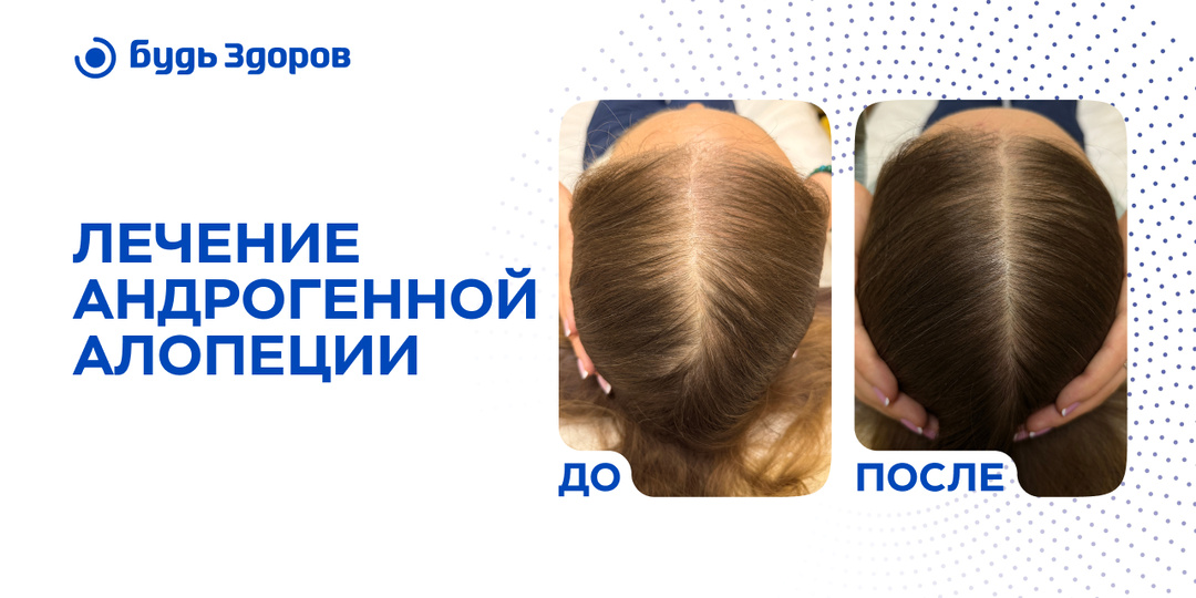 Клинический случай: лечение андрогенной алопеции