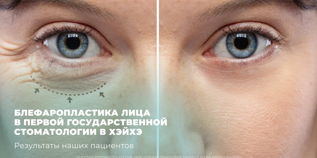 Как навсегда избавиться от нависших век: до/после блефаропластики лица в Китае