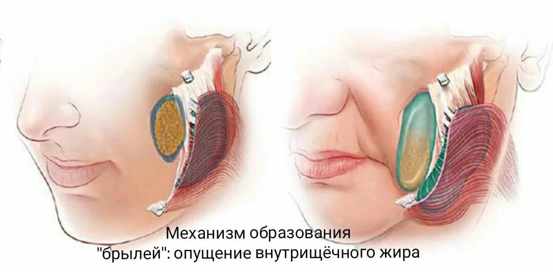 Косметолог объясняет: откуда берутся брыли и можно ли от них избавиться?
