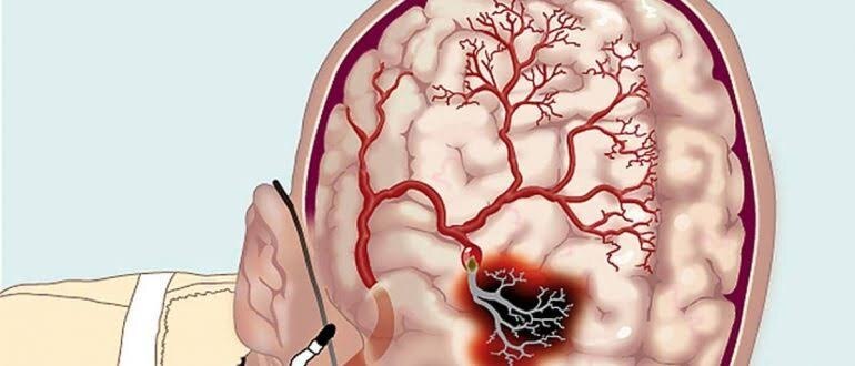 7 признаков, что мозг недополучает кислород