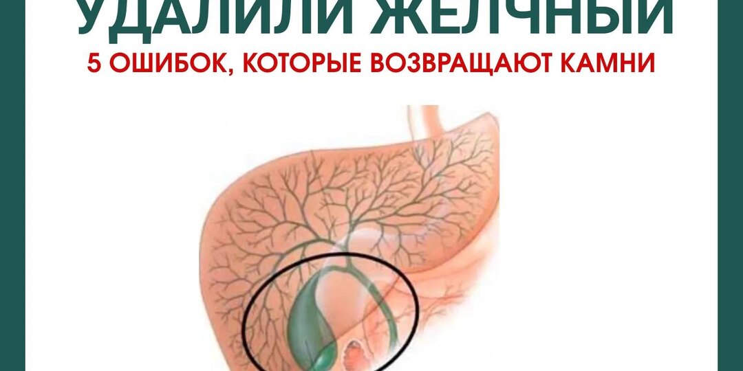Жизнь после удаления желчного пузыря: 5 ошибок, которые возвращают камни