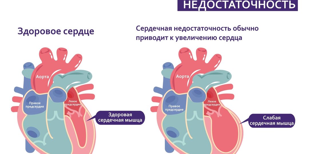 Симптомы сердечной недостаточности — организм предупреждает заранее