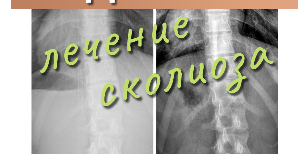 Идеальное лечение сколиоза