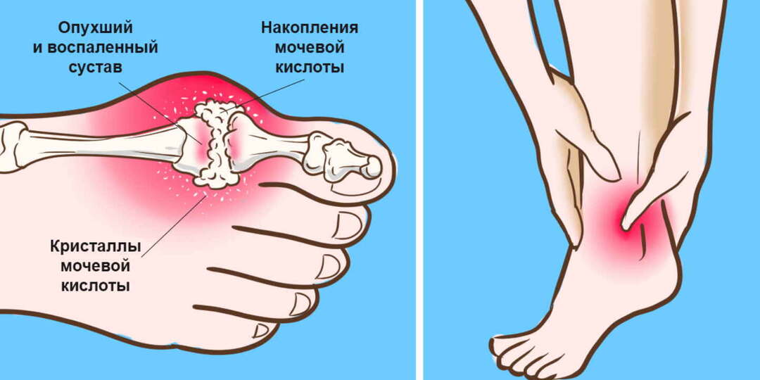 Повышенная мочевая кислота — 7 тревожных признаков