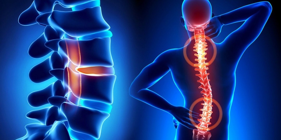 «Остеохондроз» в российских поликлиниках — диагноз-хамелеон, который чаще всего не имеет отношения к реальной болезни