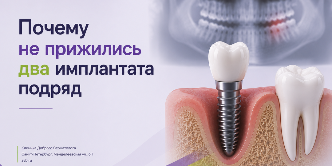 Почему у этой пациентки не прижились два имплантата
