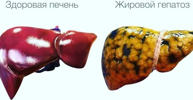 Симптомы жирового гепатоза. Как вовремя распознать ожирение печени и очистить ее от висцерального жира