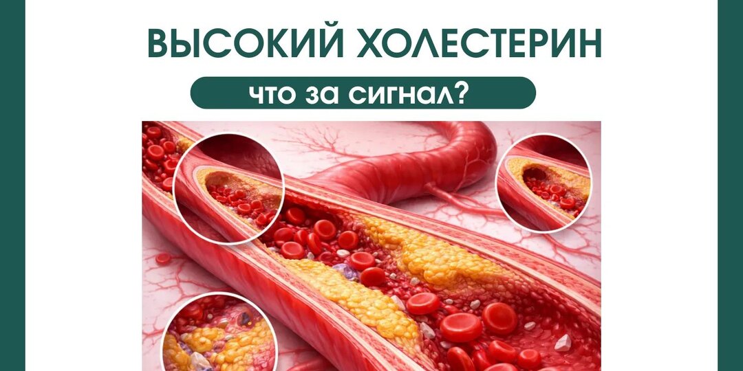 Холестерин высокий, а вы чувствуете себя хорошо?