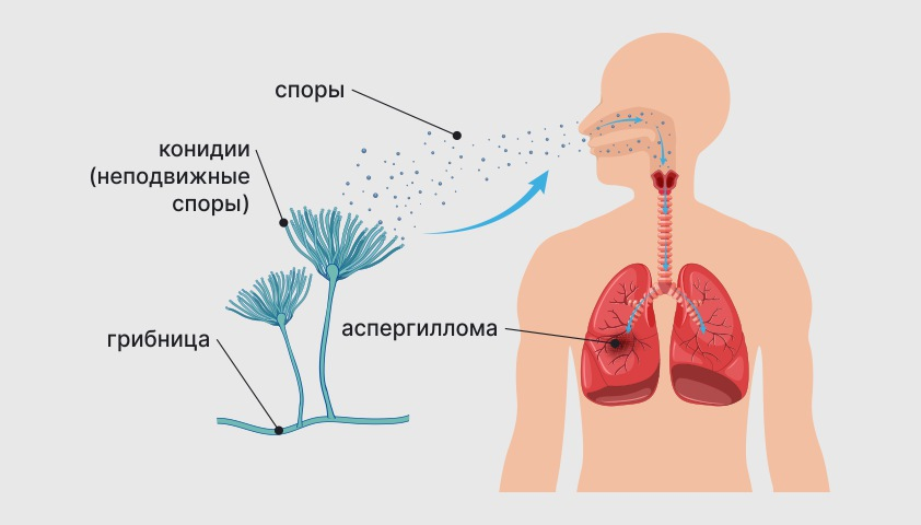 Аспергиллёз у человека