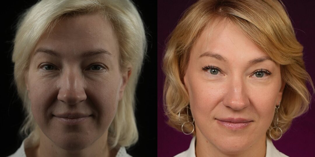 Результат через год после комплексного омоложения лица