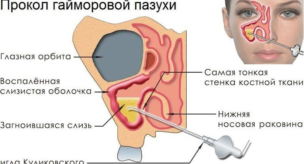 ИГЛА КУЛИКОВСКОГО