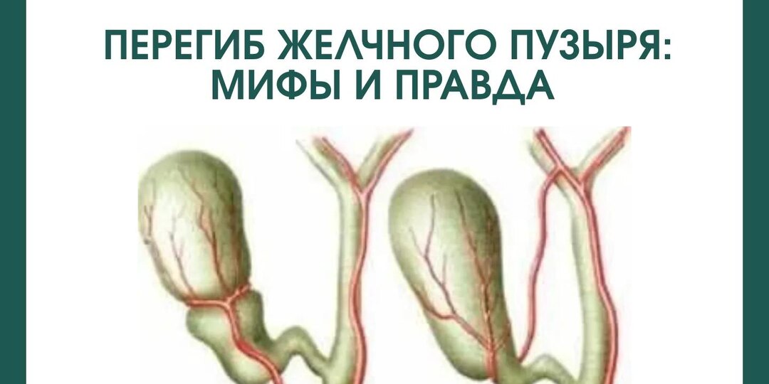 Перегиб желчного пузыря: мифы и правда