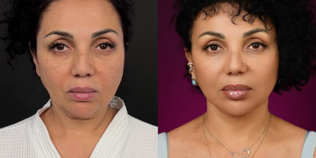 Результат через 2,5 года после Total Face Complex